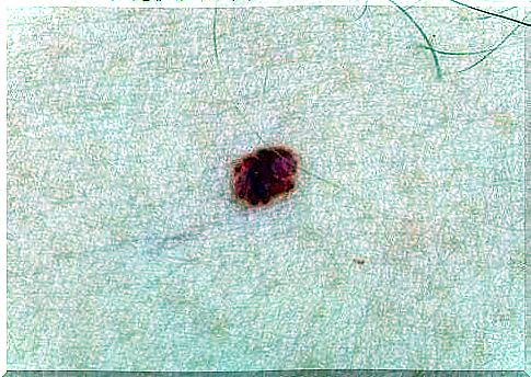 How is a skin angioma treated in babies?