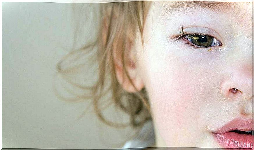 Conjunctivitis in children