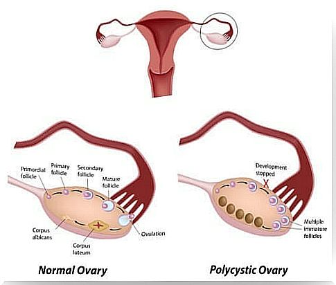 Illustration of the polycystic ovary