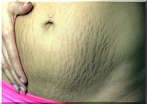 Postpartum stretch marks: how to prevent and eliminate them