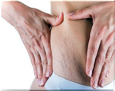 How to prevent white stretch marks